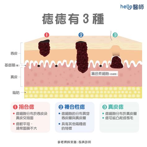 臉 長痣|痣變大、痣多或長毛會變皮膚癌？認識痣的形成與原因